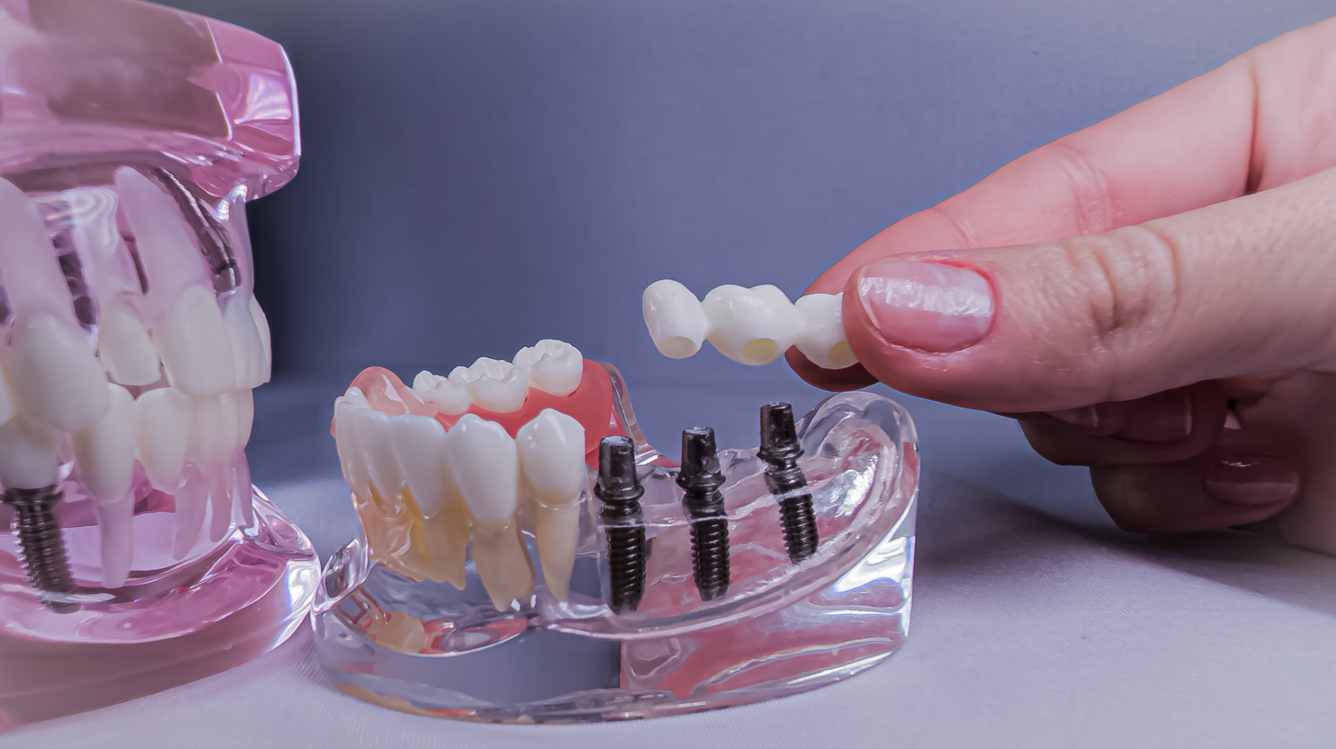 Hand lowering a three-tooth bridge onto three implant posts in a clear jaw model, how each segment of a 3-on-6 restoration seats on its own implants