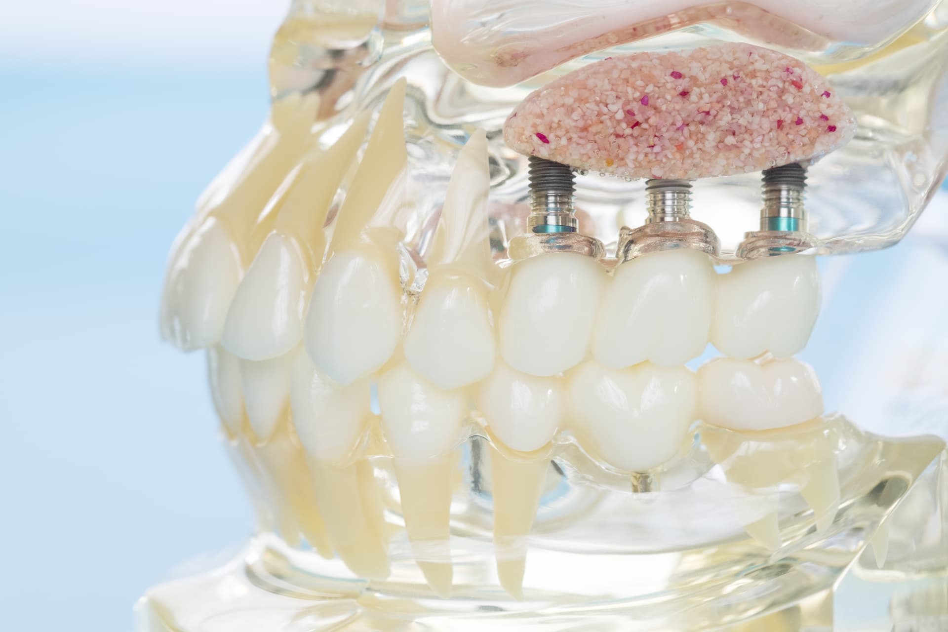 Clear anatomical jaw model showing three dental implants and pink bone graft material in the upper back of the jaw, the posterior bone a 3-on-6 restoration needs