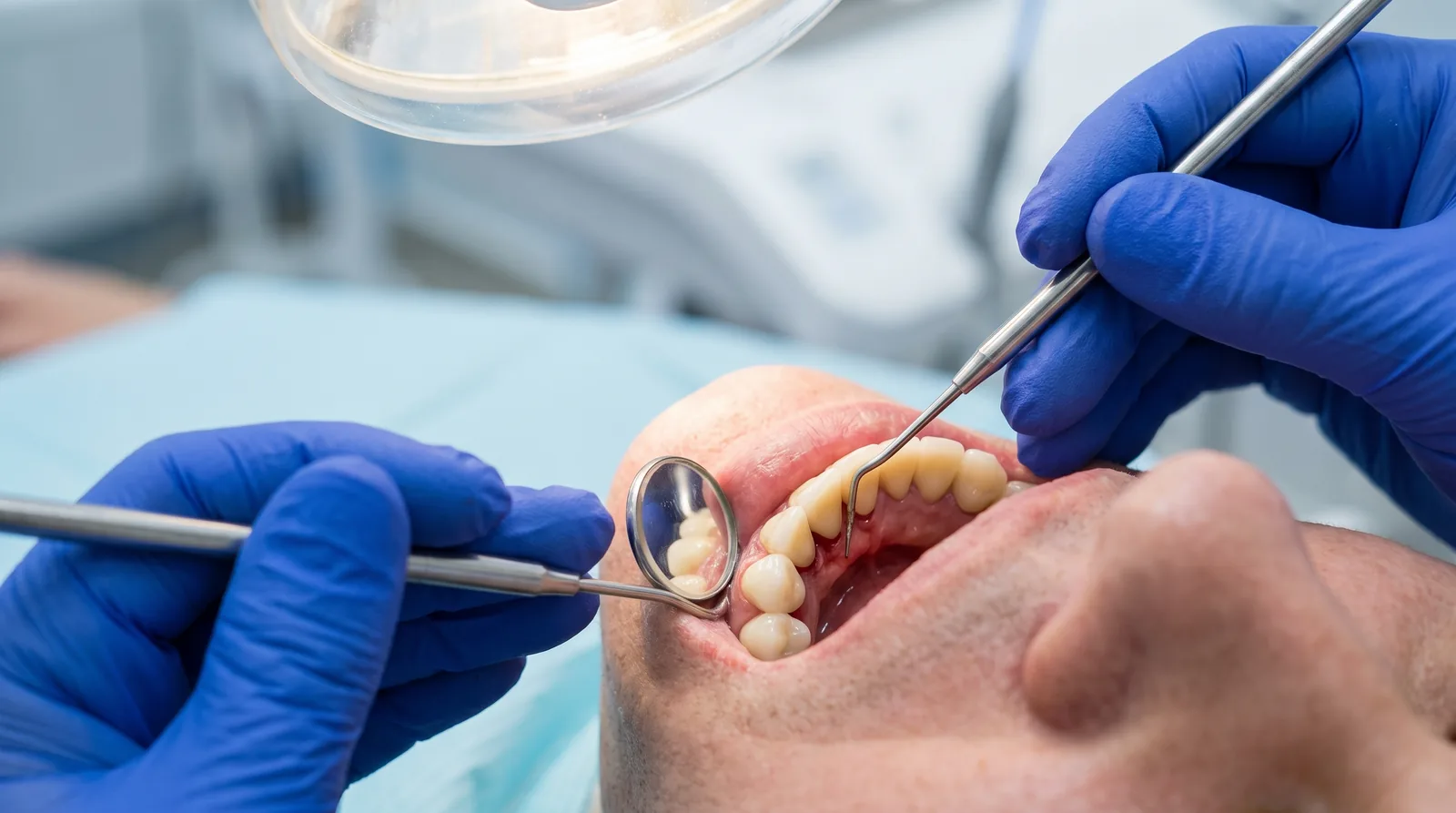Close-up of a dentist inspecting a full-arch implant bridge with a mirror and probe during a maintenance visit