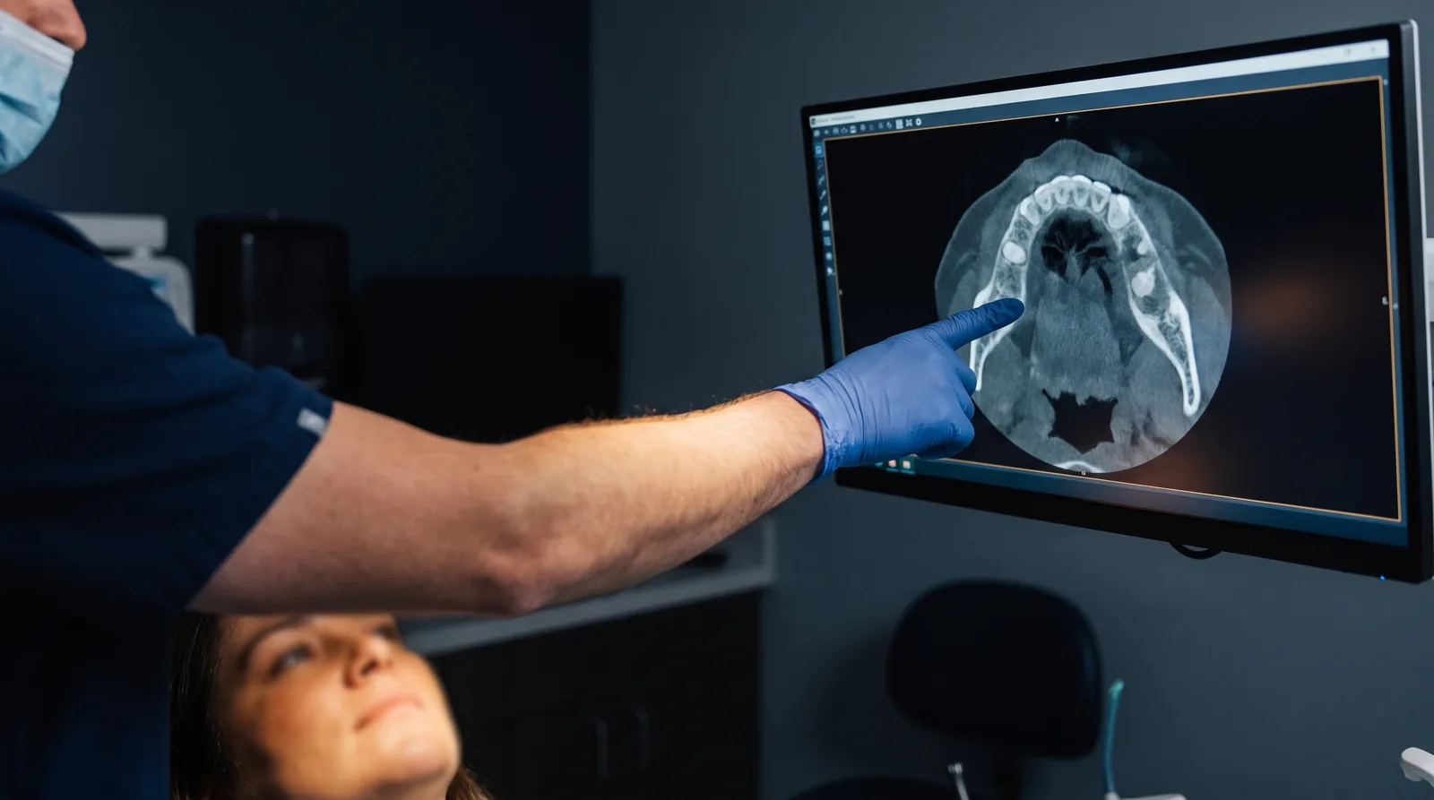 Cone-beam CT scan on a monitor with a surgeon pointing to bone density in the upper jaw during a full-arch consultation