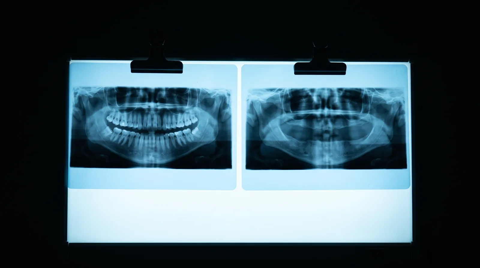Side-by-side jaw X-rays showing a healthy jawbone next to one with advanced bone loss after years of denture wear