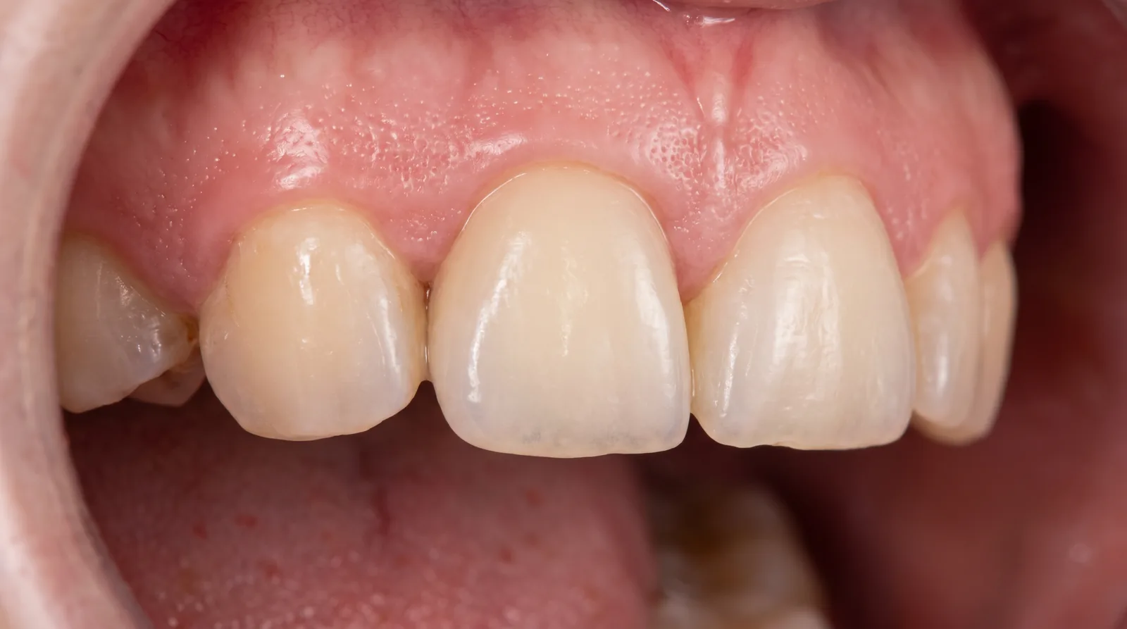 Close-up of a single implant crown between two untouched natural teeth, healthy gum, clinical photograph