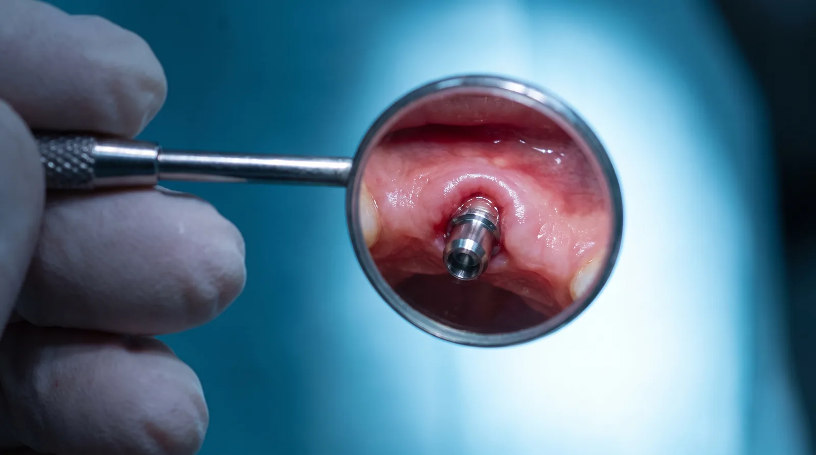 Close-up of a dental implant site healing in the gum, viewed with a dental mirror under clinic light