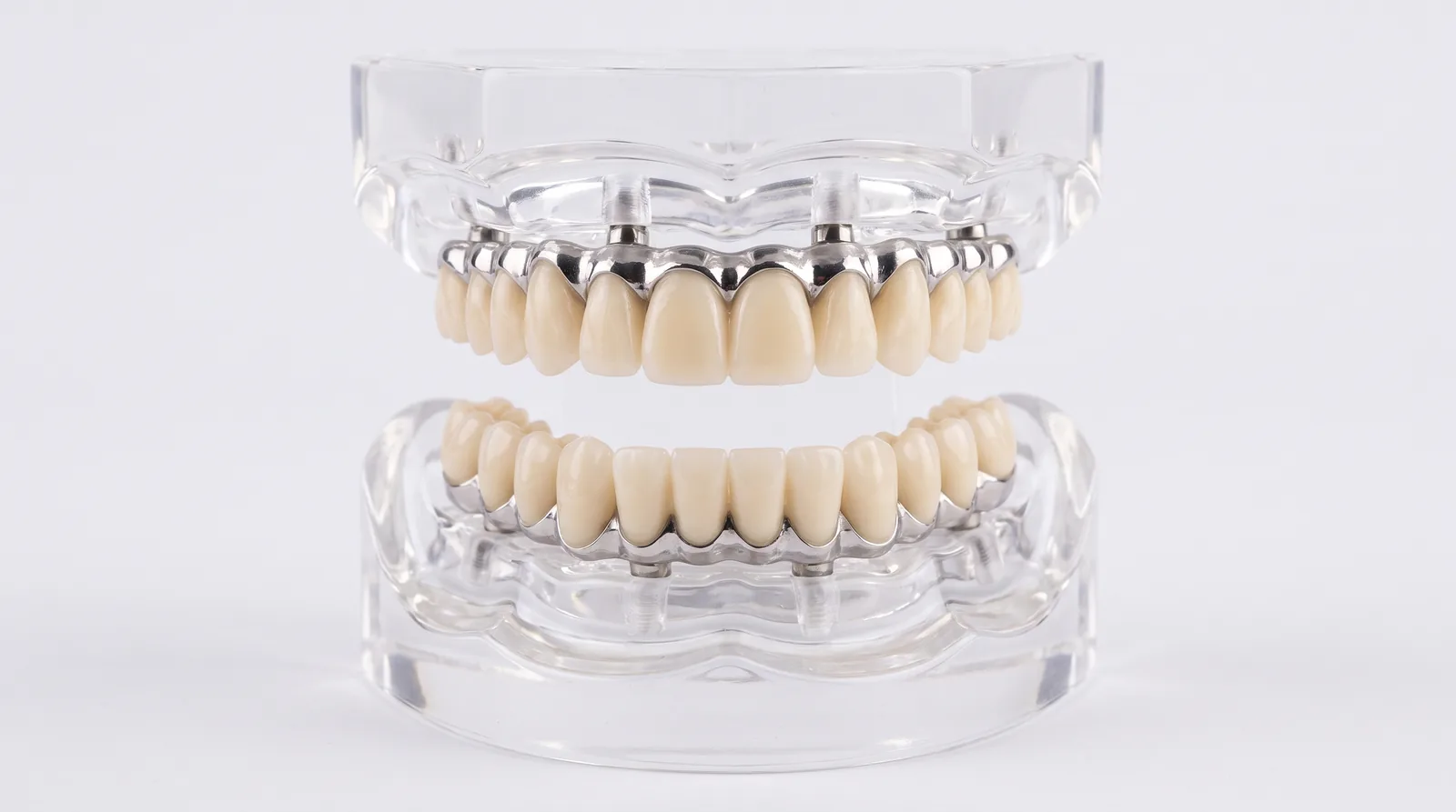 Upper and lower full-arch implant bridges displayed together on a dental lab stand under clean studio light