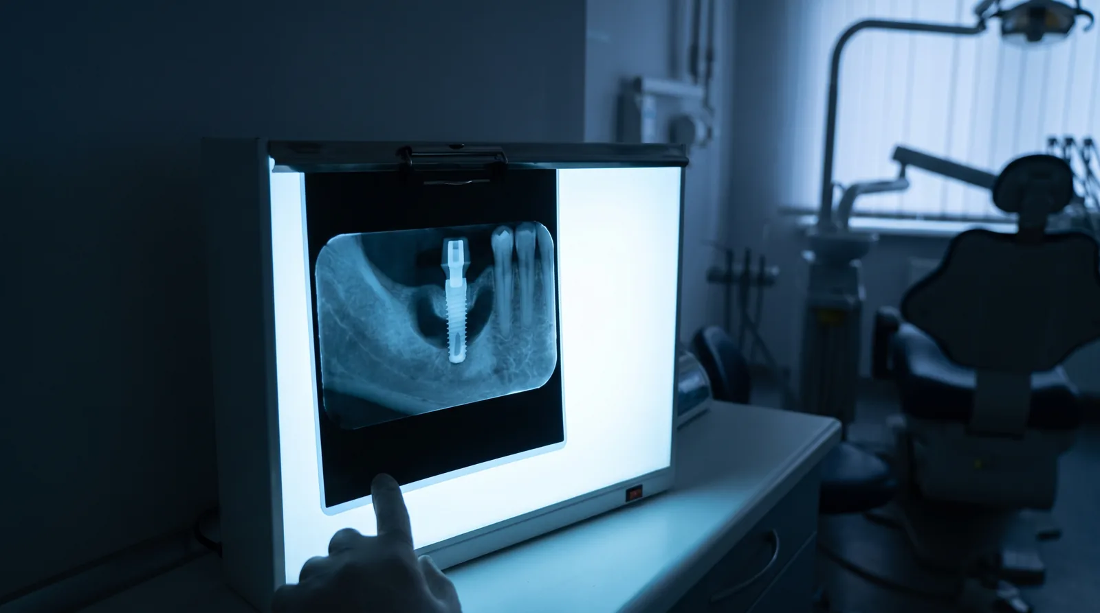 Dental X-ray on a light box showing an implant with a dark crescent of bone loss around its neck, dim clinic room
